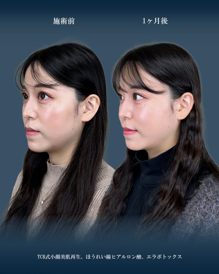 小顔美肌再生（リフトアップ）(担当医:大見 貴秀 医師)の症例写真2