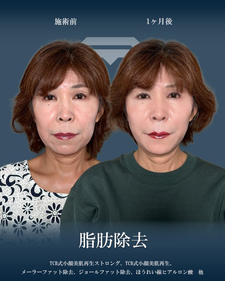 ジョールファット除去(担当医:大見 貴秀 医師)の症例写真1