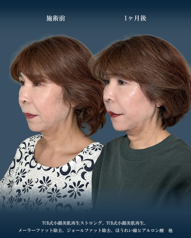 ジョールファット除去(担当医:大見 貴秀 医師)の症例写真2