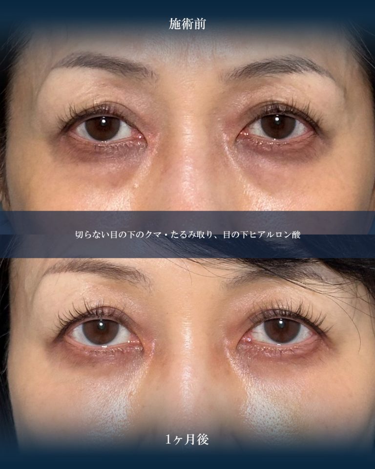 切らない目の下のクマ取り・目の下のたるみ（ふくらみ）取り(担当医:大見 貴秀 医師)の症例写真1
