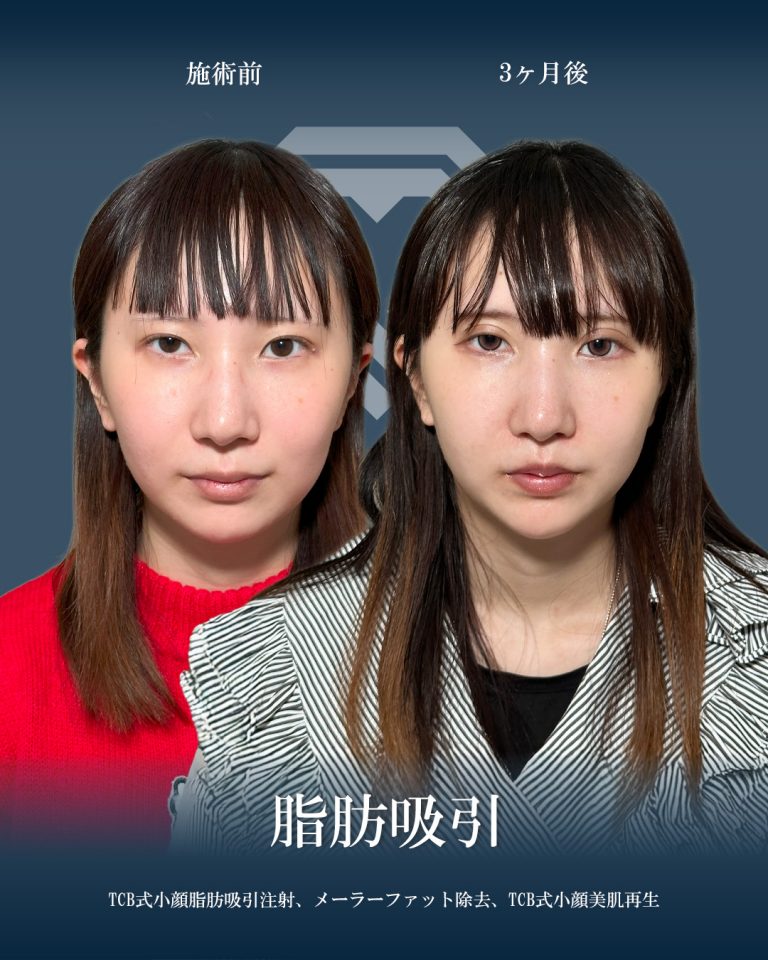 顔の脂肪吸引(担当医:大見 貴秀 医師)の症例写真1