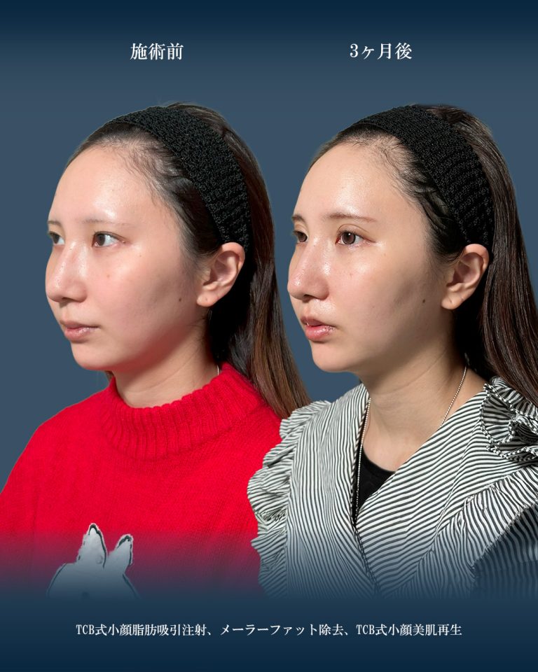 顔の脂肪吸引(担当医:大見 貴秀 医師)の症例写真2