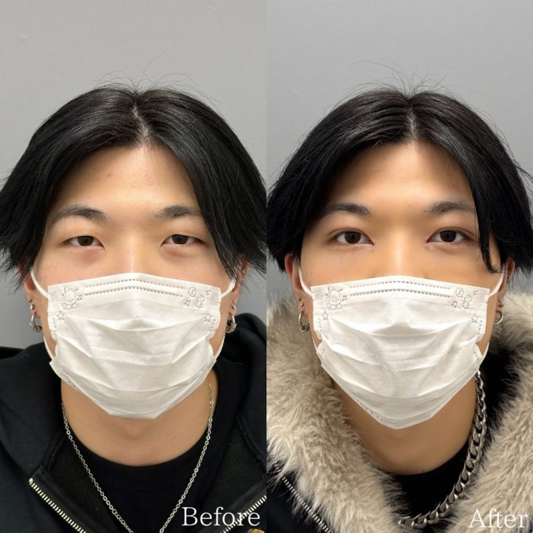 切らない目の下のクマ取り・目の下のたるみ（ふくらみ）取り(担当医:佐野 孝治 医師)の症例写真1