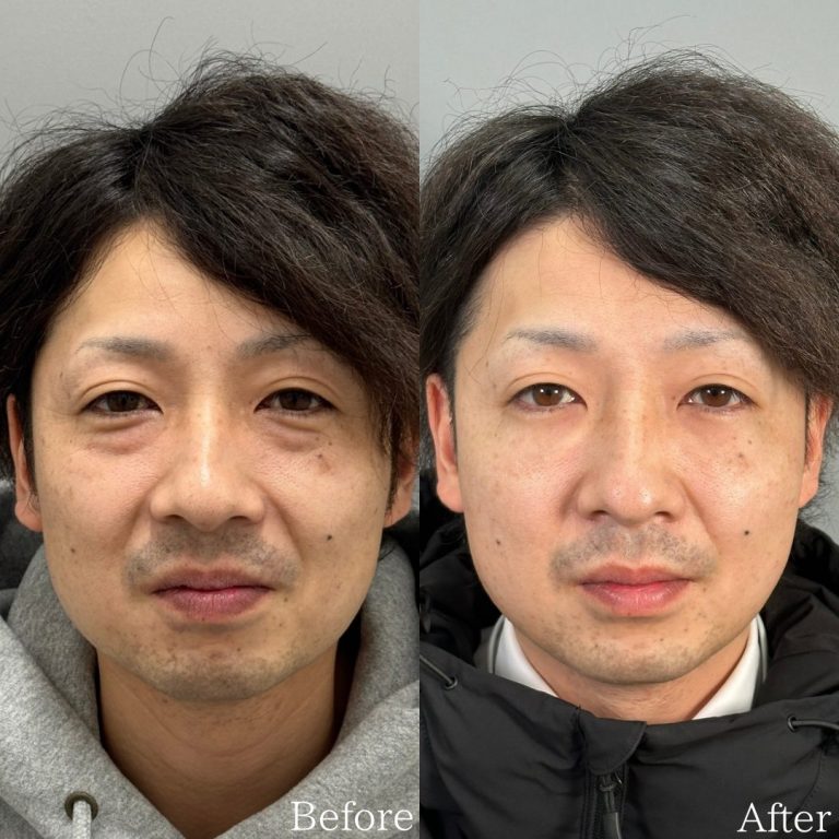 切らない目の下のクマ取り・目の下のたるみ（ふくらみ）取り(担当医:佐野 孝治 医師)の症例写真1