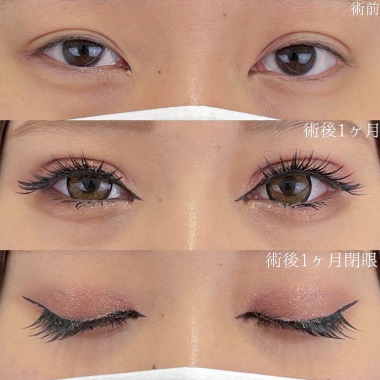 二重埋没法(担当医:佐野 孝治 医師)の症例写真1