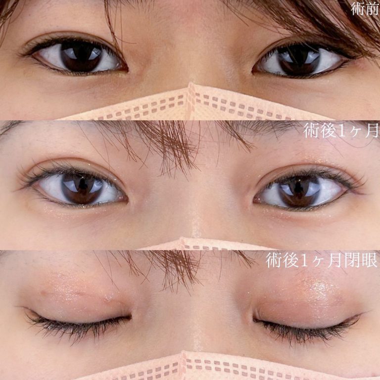 二重埋没法(担当医:佐野 孝治 医師)の症例写真1