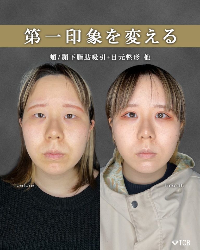 顔の脂肪吸引(担当医:富田 秀鷹 医師)の症例写真1