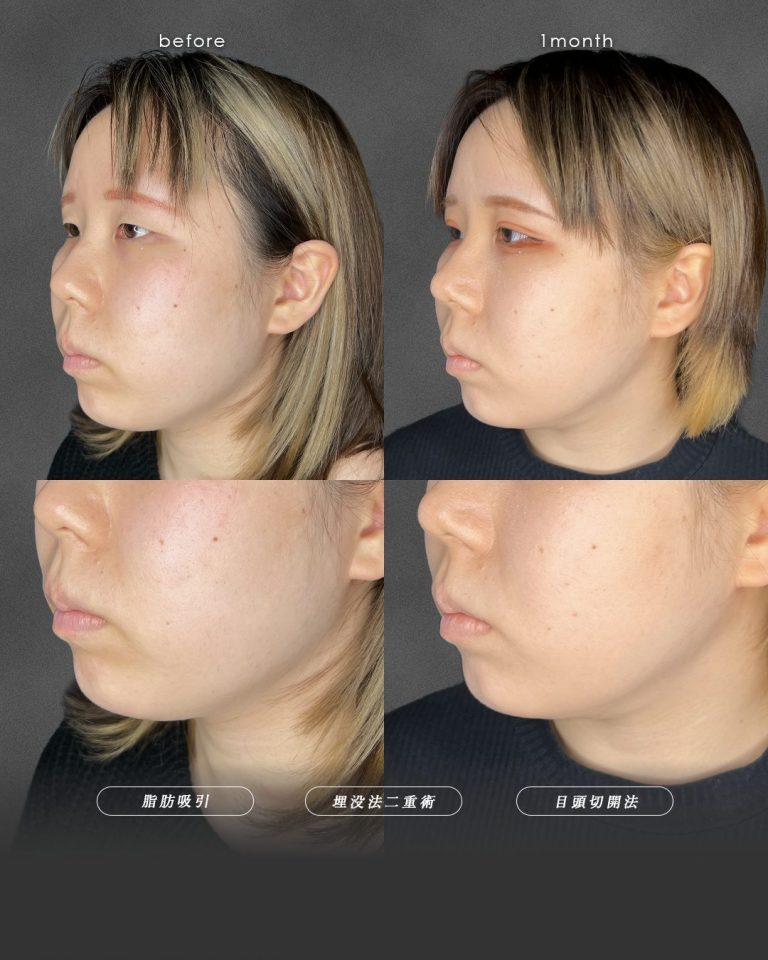 顔の脂肪吸引(担当医:富田 秀鷹 医師)の症例写真3