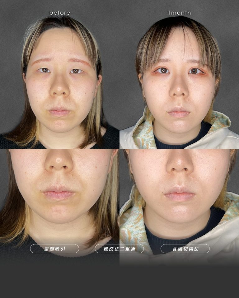 顔の脂肪吸引(担当医:富田 秀鷹 医師)の症例写真2