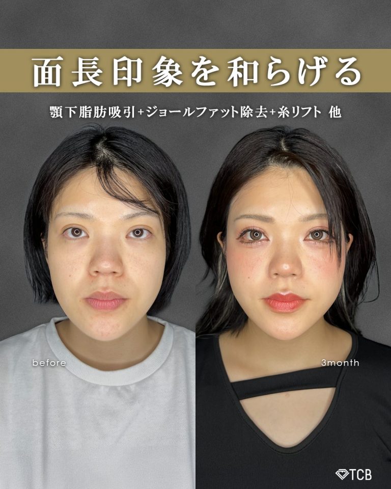 顔の脂肪吸引(担当医:富田 秀鷹 医師)の症例写真1