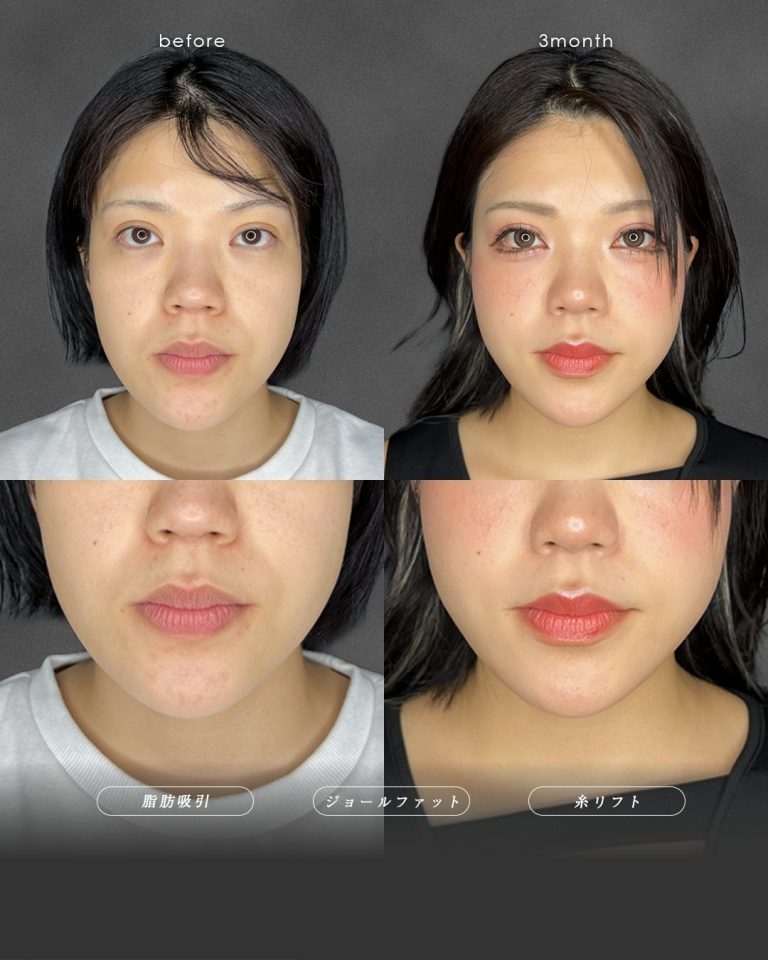 顔の脂肪吸引(担当医:富田 秀鷹 医師)の症例写真3