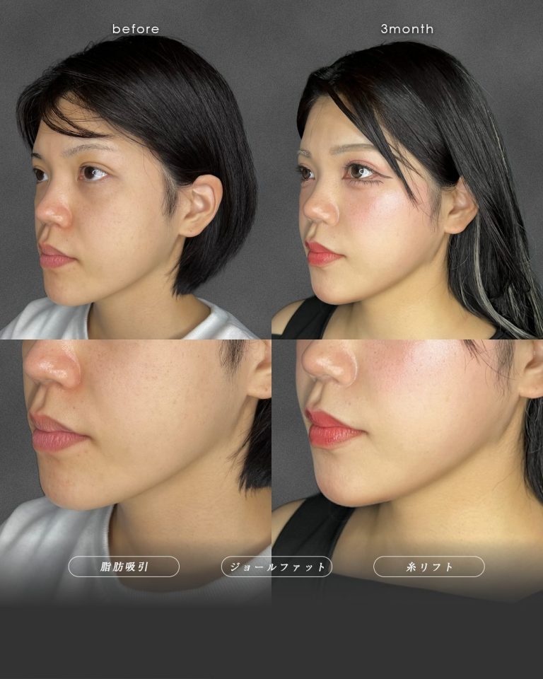 顔の脂肪吸引(担当医:富田 秀鷹 医師)の症例写真2