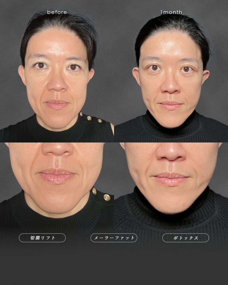 切開リフト（フェイスリフト・ミニフェイスリフト）(担当医:富田 秀鷹 医師)の症例写真2