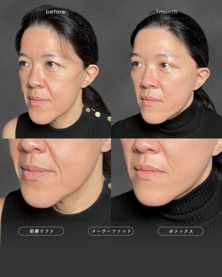 切開リフト（フェイスリフト・ミニフェイスリフト）(担当医:富田 秀鷹 医師)の症例写真3