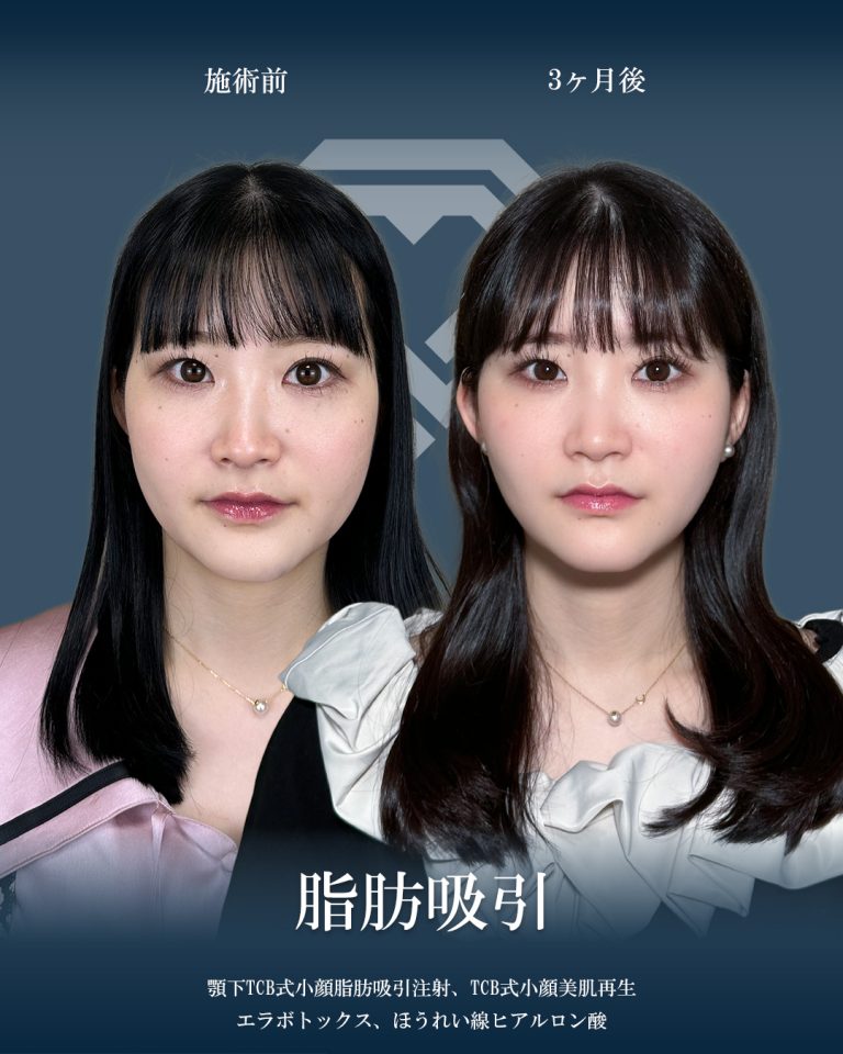 顔の脂肪吸引(担当医:大見 貴秀 医師)の症例写真1