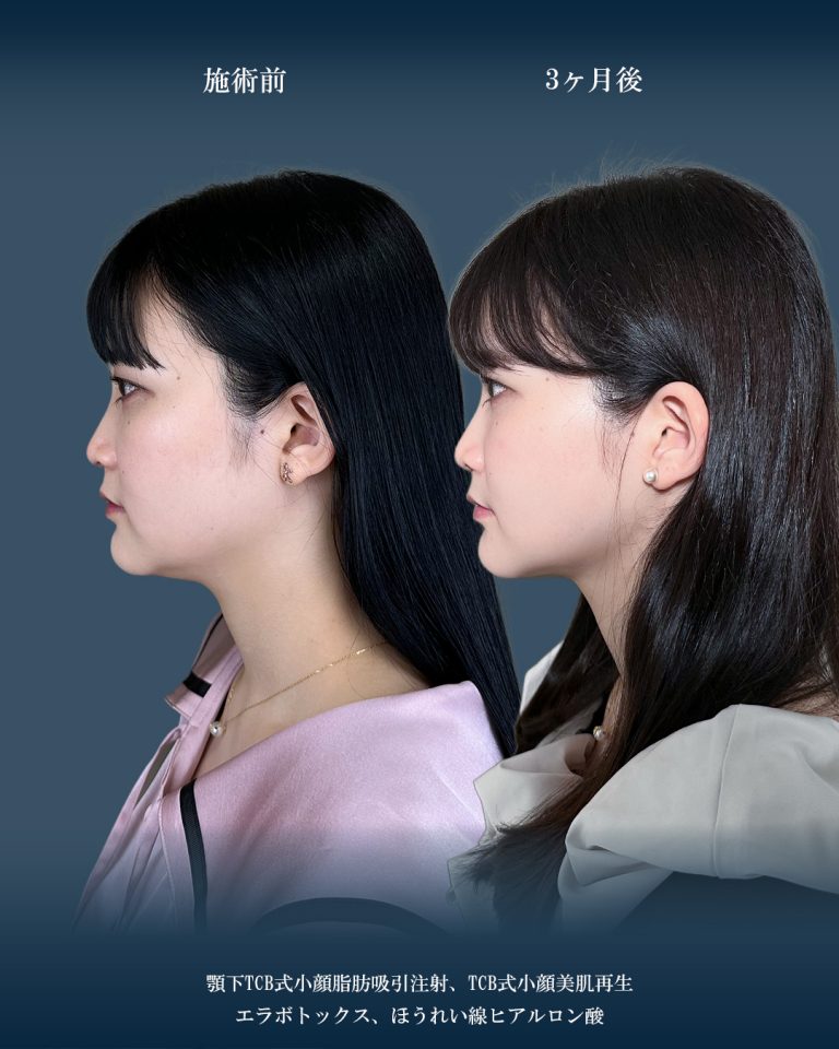 顔の脂肪吸引(担当医:大見 貴秀 医師)の症例写真2