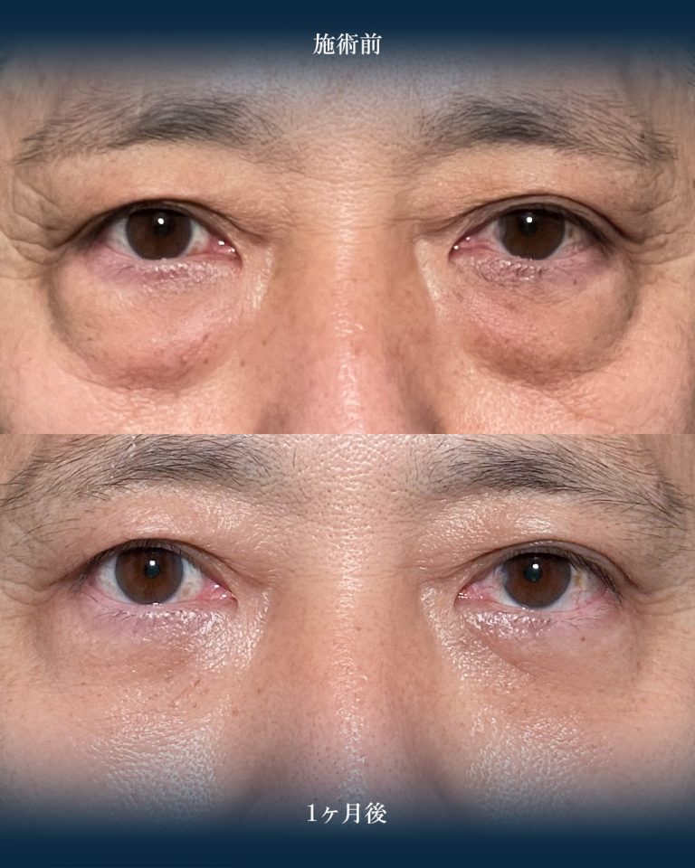 切らない目の下のクマ取り・目の下のたるみ（ふくらみ）取り(担当医:大見 貴秀 医師)の症例写真1