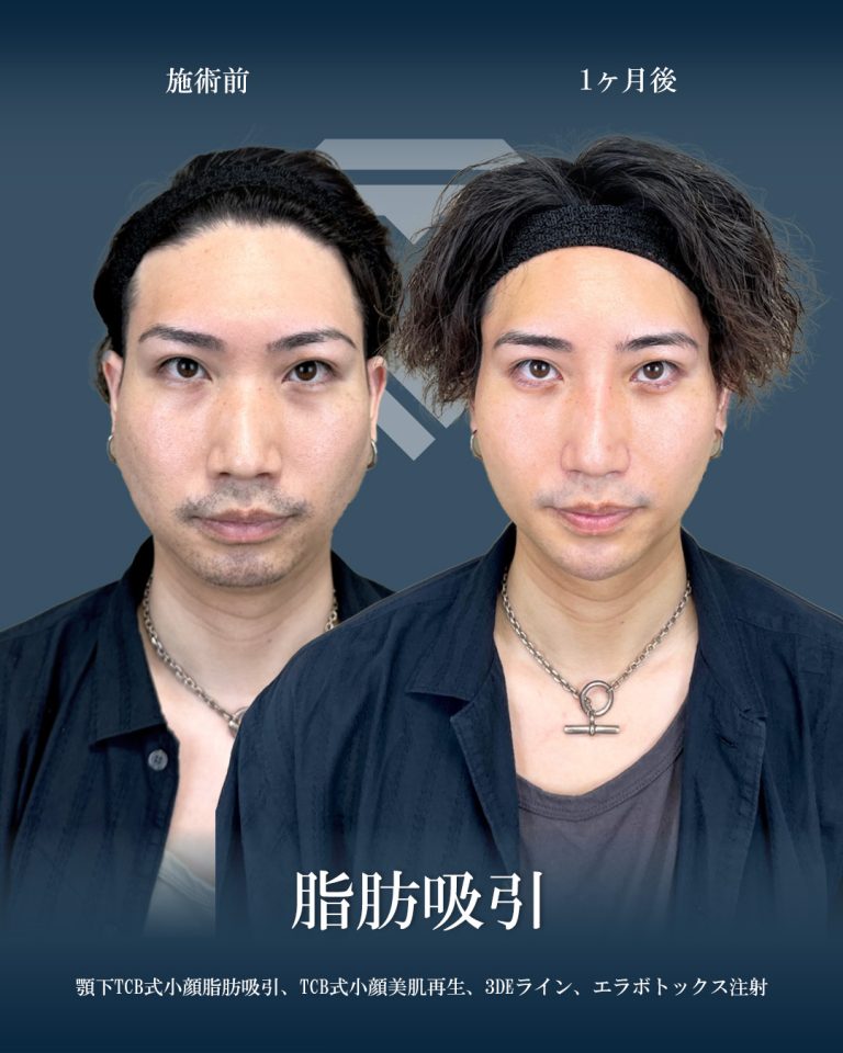 顔の脂肪吸引(担当医:大見 貴秀 医師)の症例写真1