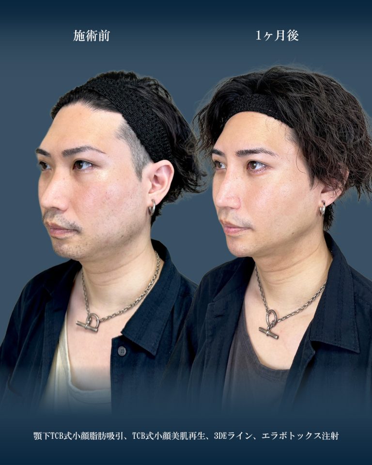 顔の脂肪吸引(担当医:大見 貴秀 医師)の症例写真2