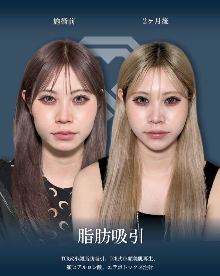 顔の脂肪吸引(担当医:大見 貴秀 医師)の症例写真1