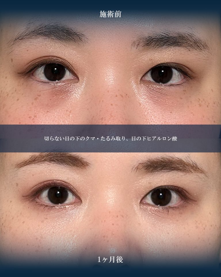 切らない目の下のクマ取り・目の下のたるみ（ふくらみ）取り(担当医:大見 貴秀 医師)の症例写真1
