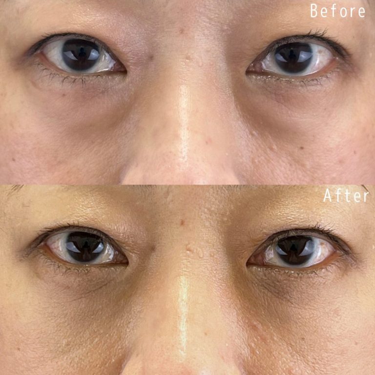 切らない目の下のクマ取り・目の下のたるみ（ふくらみ）取り(担当医:佐野 孝治 医師)の症例写真1