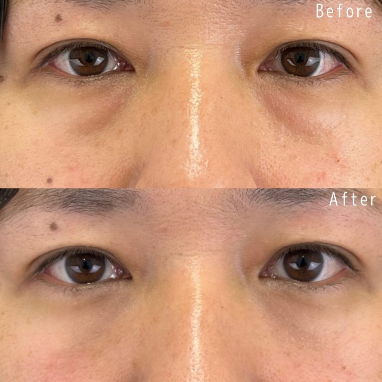 切らない目の下のクマ取り・目の下のたるみ（ふくらみ）取り(担当医:佐野 孝治 医師)の症例写真1