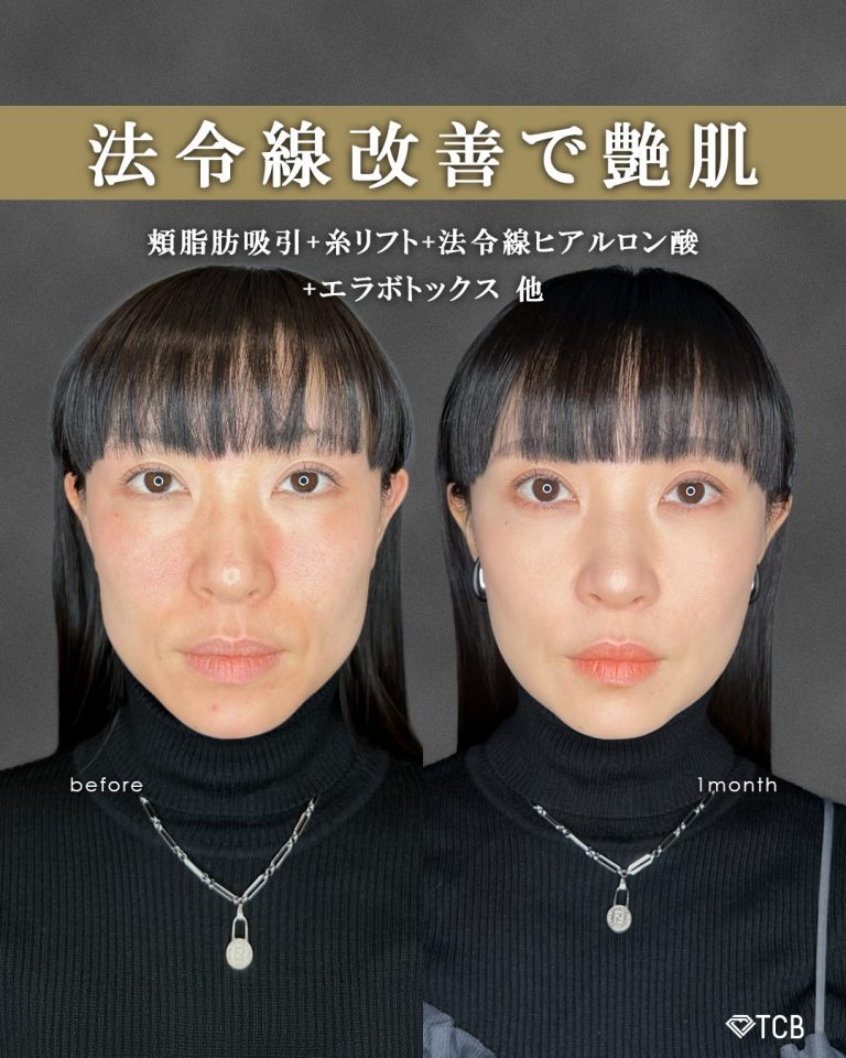 顔の脂肪吸引(担当医:富田 秀鷹 医師)の症例写真1