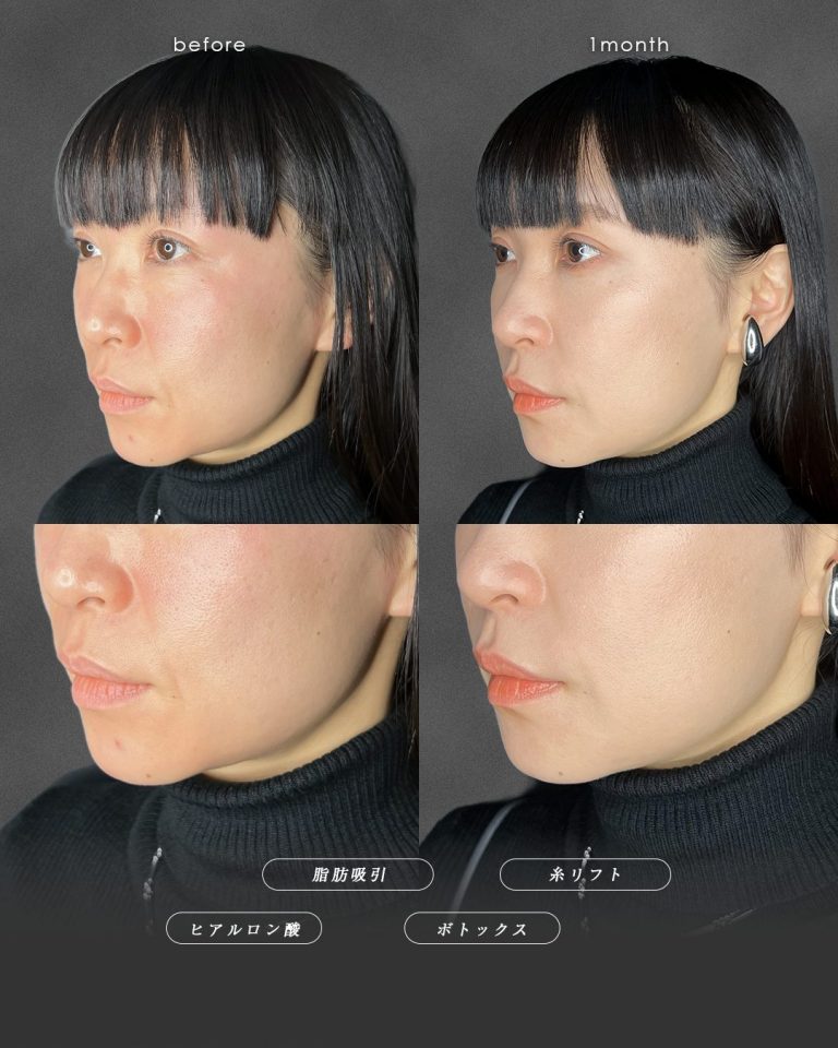 顔の脂肪吸引(担当医:富田 秀鷹 医師)の症例写真2