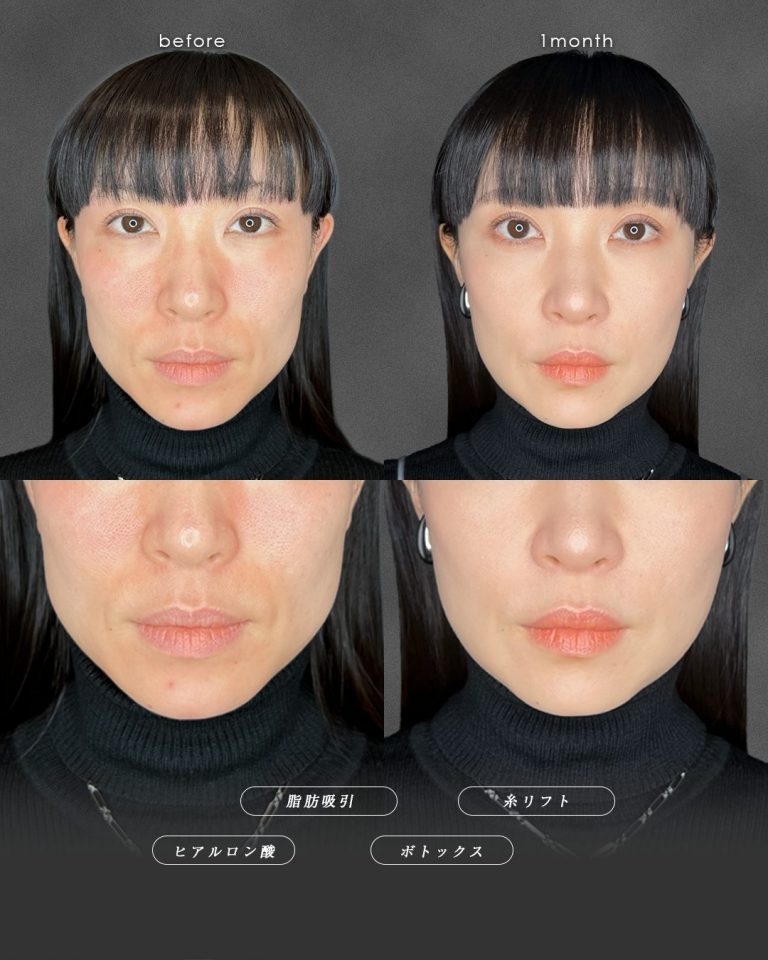 顔の脂肪吸引(担当医:富田 秀鷹 医師)の症例写真3