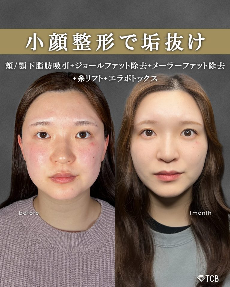 顔の脂肪吸引(担当医:富田 秀鷹 医師)の症例写真1