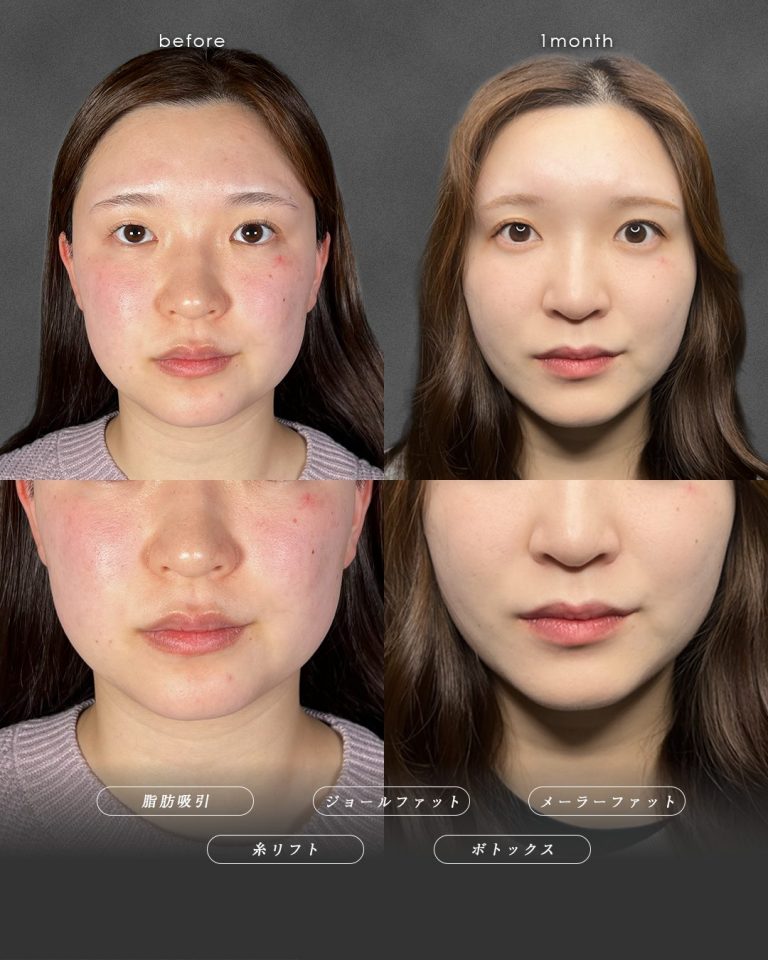 顔の脂肪吸引(担当医:富田 秀鷹 医師)の症例写真3