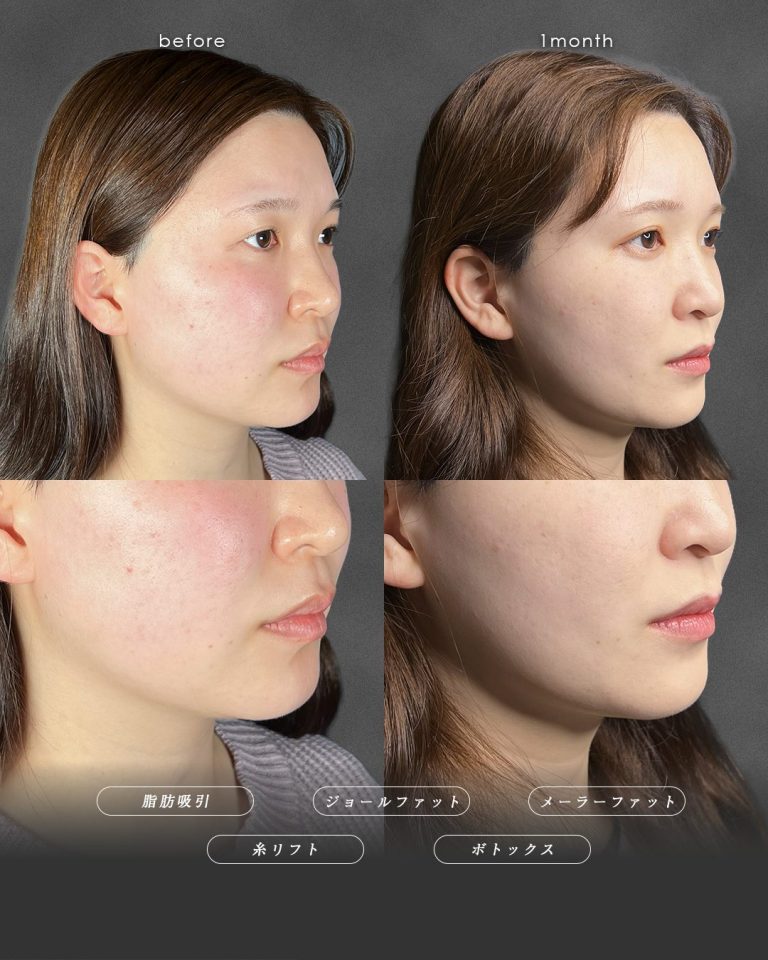 顔の脂肪吸引(担当医:富田 秀鷹 医師)の症例写真2