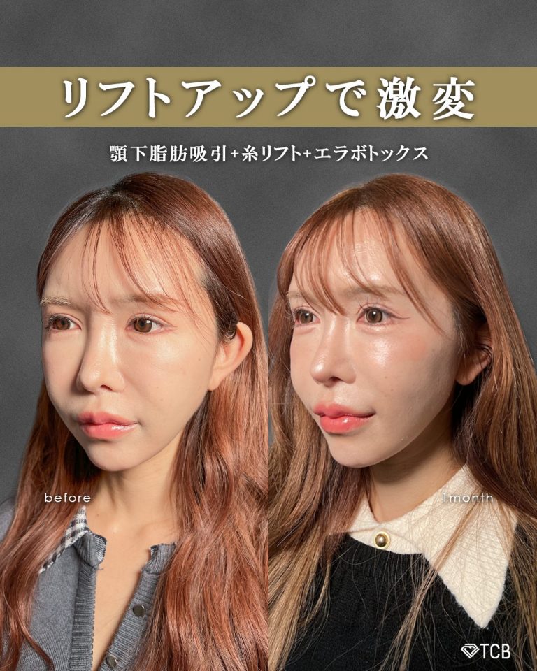 顔の脂肪吸引(担当医:富田 秀鷹 医師)の症例写真1