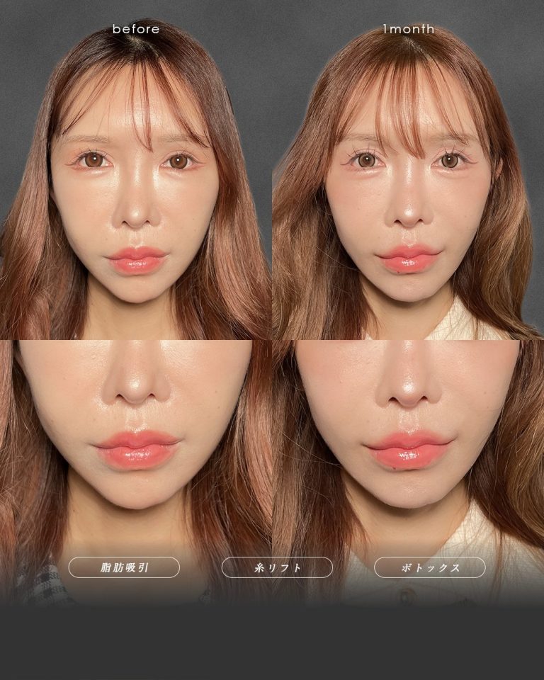 顔の脂肪吸引(担当医:富田 秀鷹 医師)の症例写真2