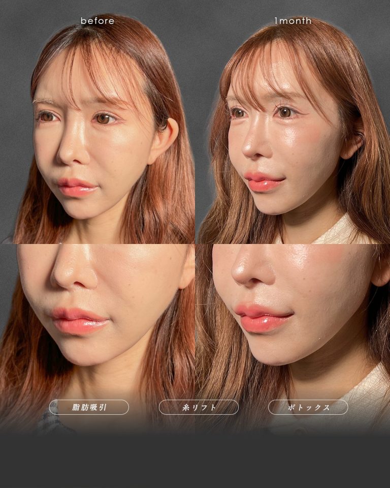 顔の脂肪吸引(担当医:富田 秀鷹 医師)の症例写真3