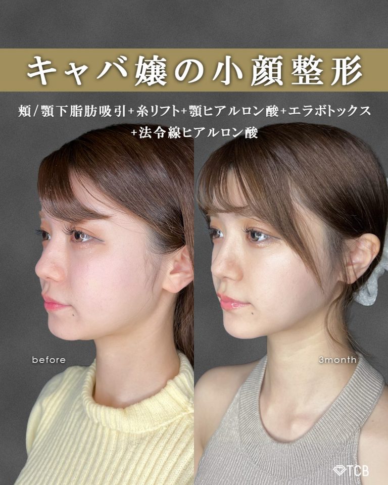 顔の脂肪吸引(担当医:富田 秀鷹 医師)の症例写真1