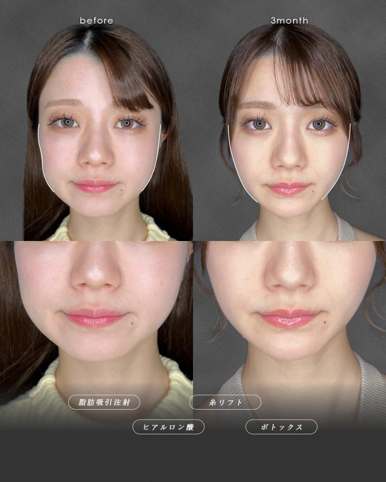 顔の脂肪吸引(担当医:富田 秀鷹 医師)の症例写真2