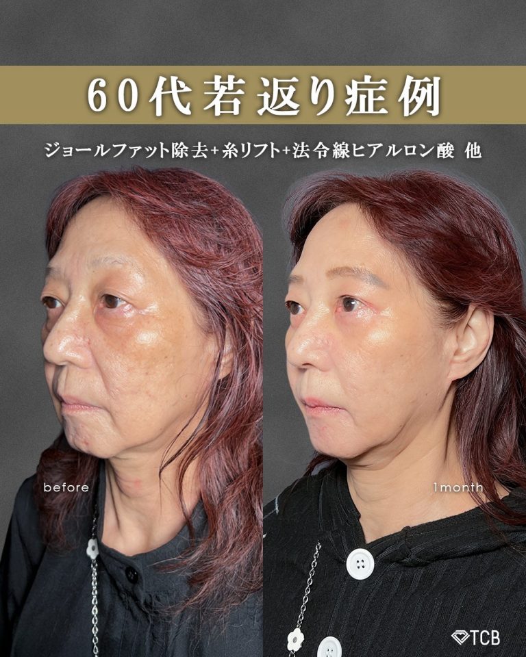 ジョールファット除去(担当医:富田 秀鷹 医師)の症例写真1