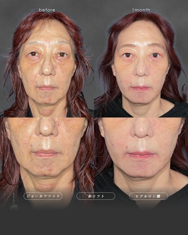 ジョールファット除去(担当医:富田 秀鷹 医師)の症例写真2