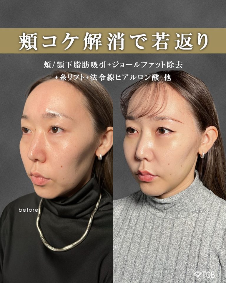 顔の脂肪吸引(担当医:富田 秀鷹 医師)の症例写真1