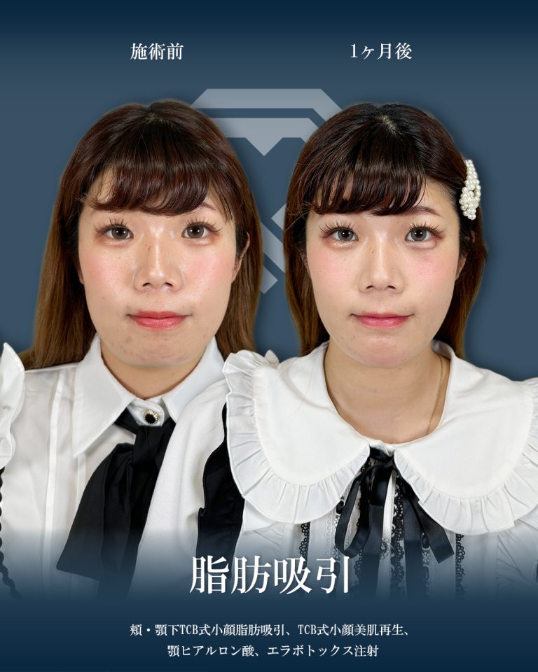 顔の脂肪吸引(担当医:大見 貴秀 医師)の症例写真1