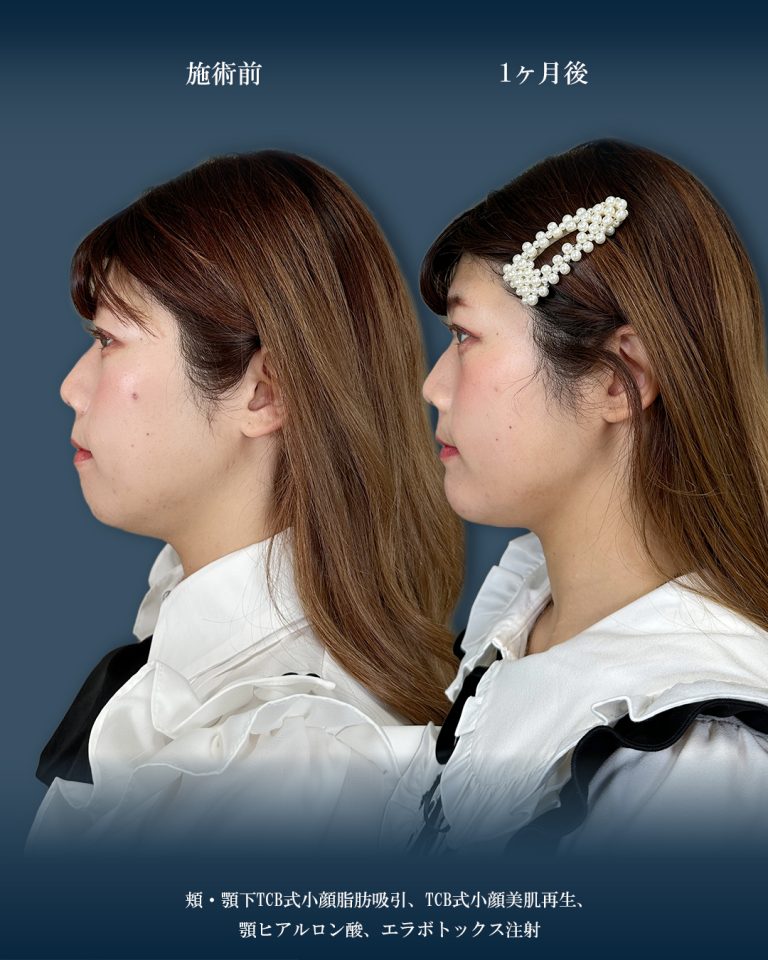 顔の脂肪吸引(担当医:大見 貴秀 医師)の症例写真2