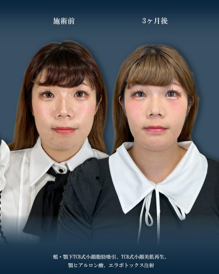 顔の脂肪吸引(担当医:大見 貴秀 医師)の症例写真3