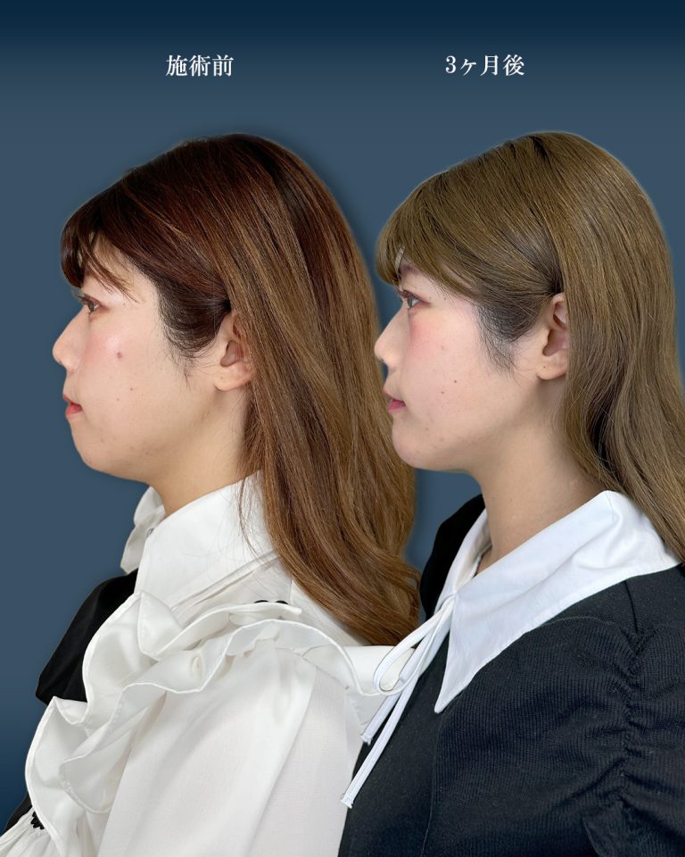 顔の脂肪吸引(担当医:大見 貴秀 医師)の症例写真4