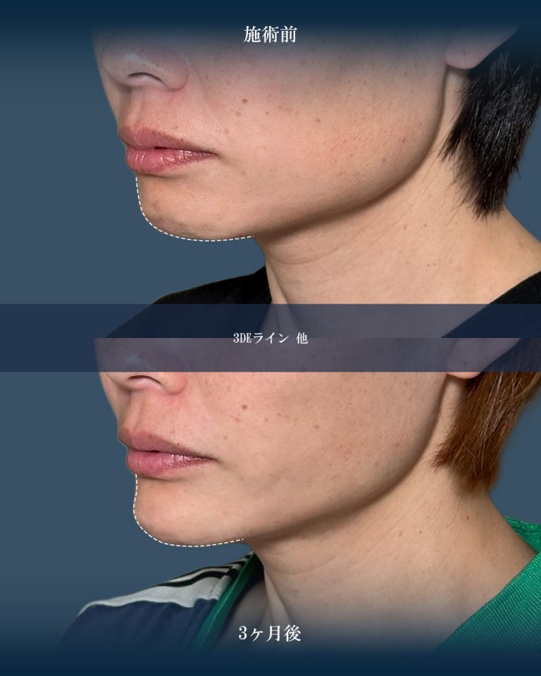 切らない顎形成 3D Eライン(担当医:大見 貴秀 医師)の症例写真1