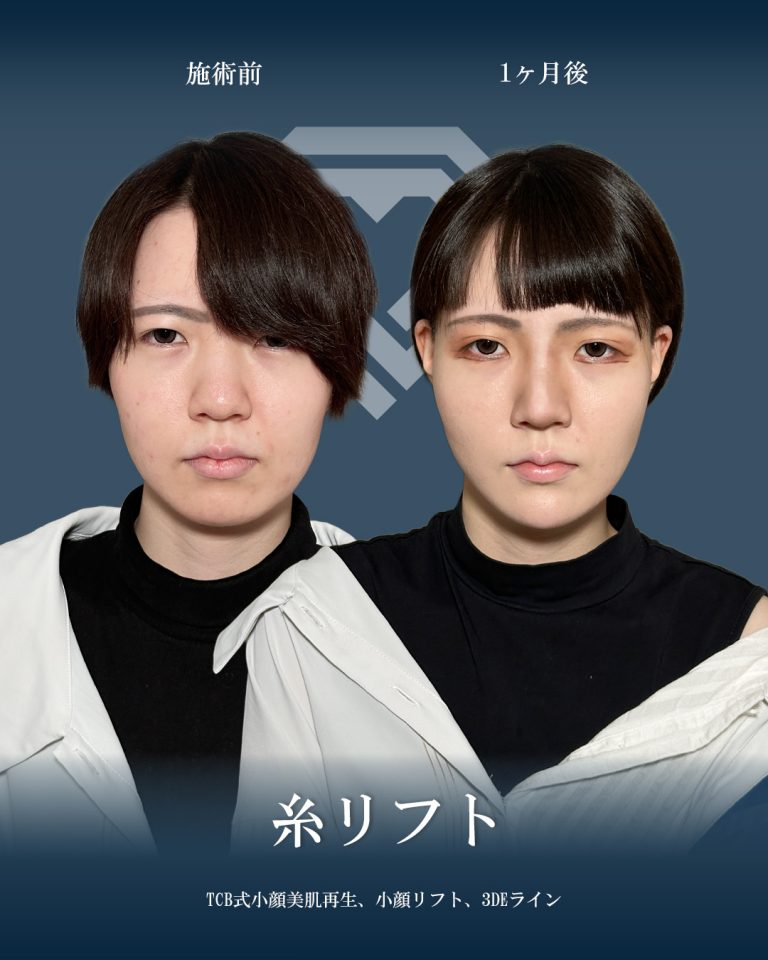 小顔美肌再生（リフトアップ）(担当医:大見 貴秀 医師)の症例写真1