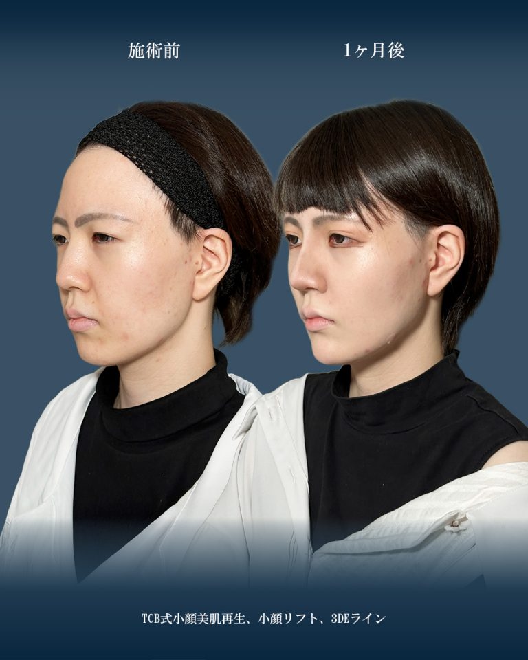 小顔美肌再生（リフトアップ）(担当医:大見 貴秀 医師)の症例写真2