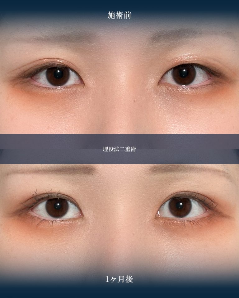 二重埋没法(担当医:大見 貴秀 医師)の症例写真1