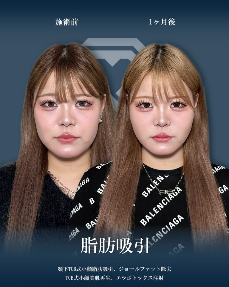 顔の脂肪吸引(担当医:大見 貴秀 医師)の症例写真1